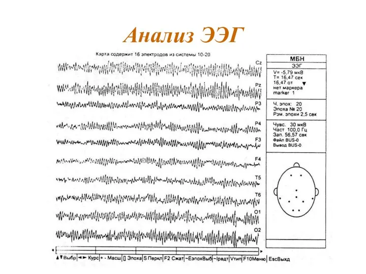 Анализ ЭЭГ