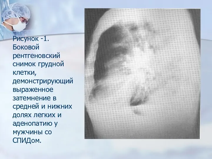 Рисунок -1. Боковой рентгеновский снимок грудной клетки, демонстрирующий выраженное затемнение