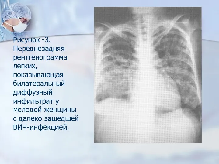Рисунок -3. Переднезадняя рентгенограмма легких, показывающая билатеральный диффузный инфильтрат у молодой женщины с далеко зашедшей ВИЧ-инфекцией.