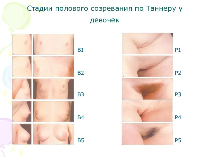 Стадии полового созревания по Таннеру у девочек B1 В2 ВЗ
