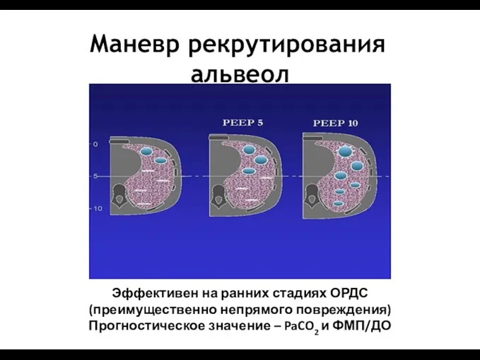 Маневр рекрутирования альвеол Эффективен на ранних стадиях ОРДС (преимущественно непрямого