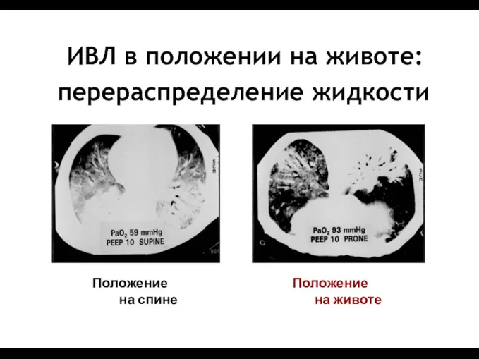 ИВЛ в положении на животе: перераспределение жидкости Положение на спине Положение на животе