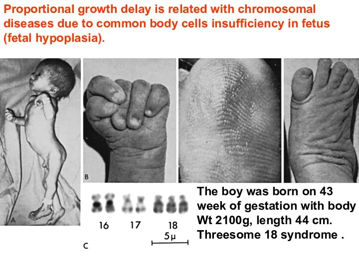 Proportional growth delay is related with chromosomal diseases due to