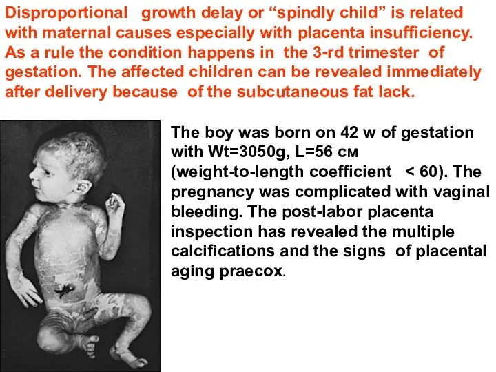 Disproportional growth delay or “spindly child” is related with maternal