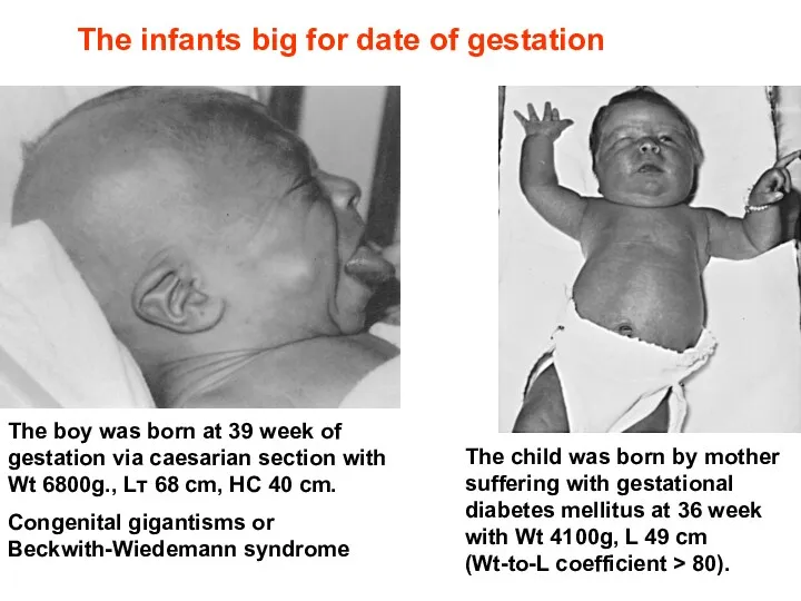 The infants big for date of gestation The boy was