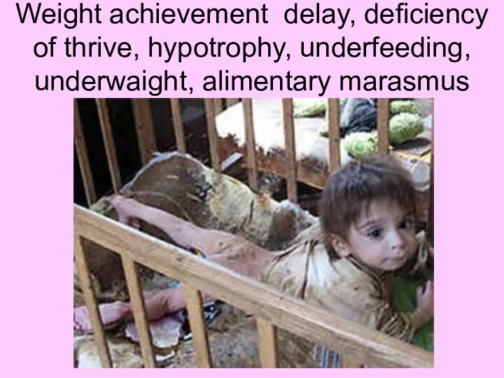Weight achievement delay, deficiency of thrive, hypotrophy, underfeeding, underwaight, alimentary marasmus