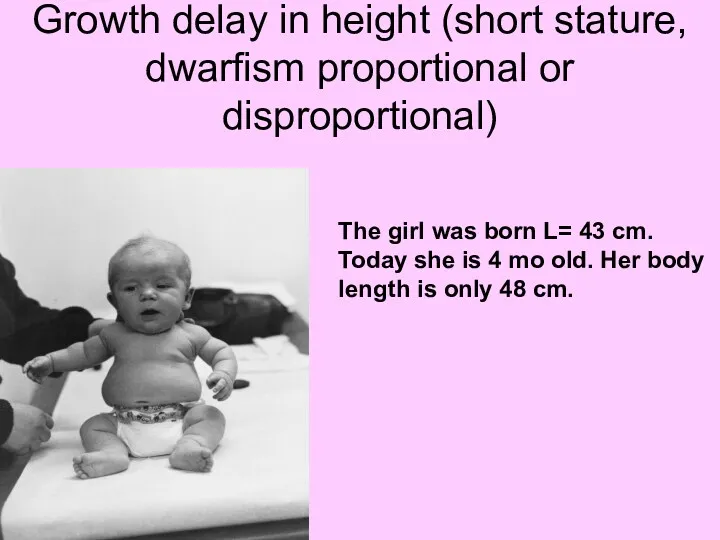 Growth delay in height (short stature, dwarfism proportional or disproportional)
