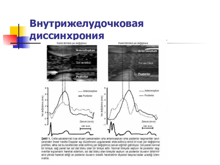 Внутрижелудочковая диссинхрония