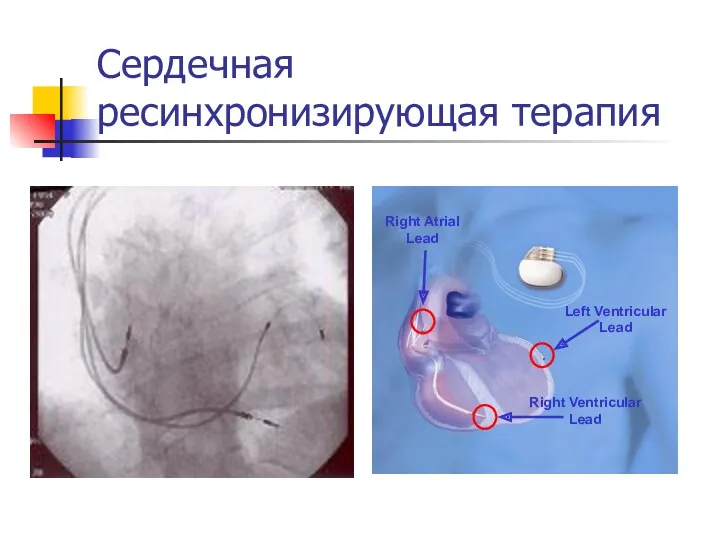 Сердечная ресинхронизирующая терапия