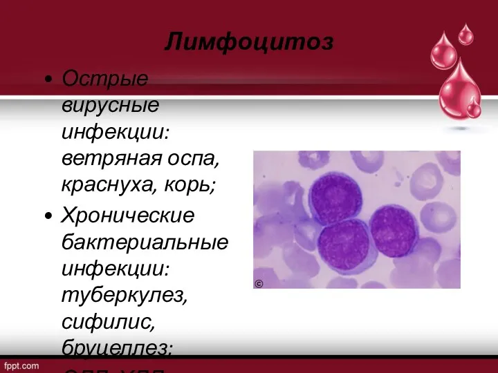 Лимфоцитоз Острые вирусные инфекции: ветряная оспа, краснуха, корь; Хронические бактериальные инфекции: туберкулез, сифилис, бруцеллез; ОЛЛ, ХЛЛ