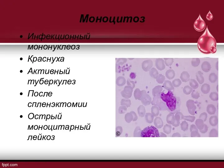 Моноцитоз Инфекционный мононуклеоз Краснуха Активный туберкулез После спленэктомии Острый моноцитарный лейкоз