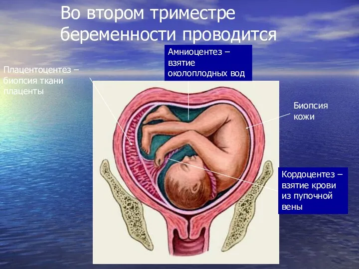 Кордоцентез – взятие крови из пупочной вены Амниоцентез – взятие