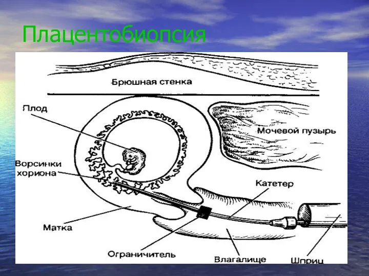 Плацентобиопсия