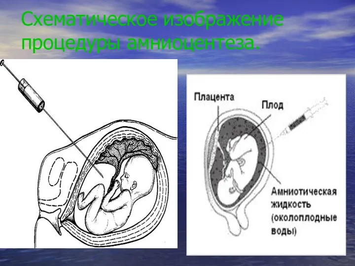 Схематическое изображение процедуры амниоцентеза.