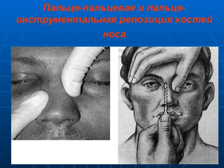 Пальце-пальцевая и пальце-инструментальная репозиция костей носа