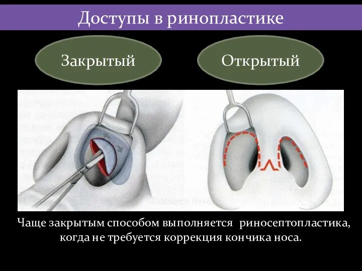 Доступы в ринопластике Закрытый Открытый Чаще закрытым способом выполняется риносептопластика, когда не требуется коррекция кончика носа.