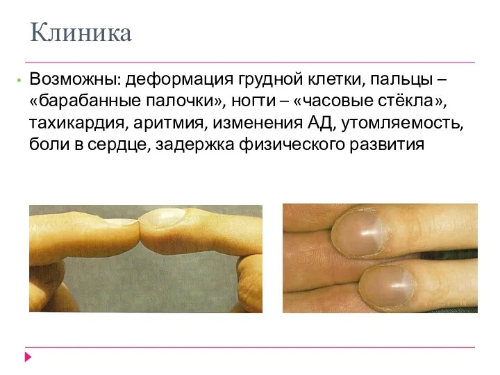Клиника Возможны: деформация грудной клетки, пальцы – «барабанные палочки», ногти