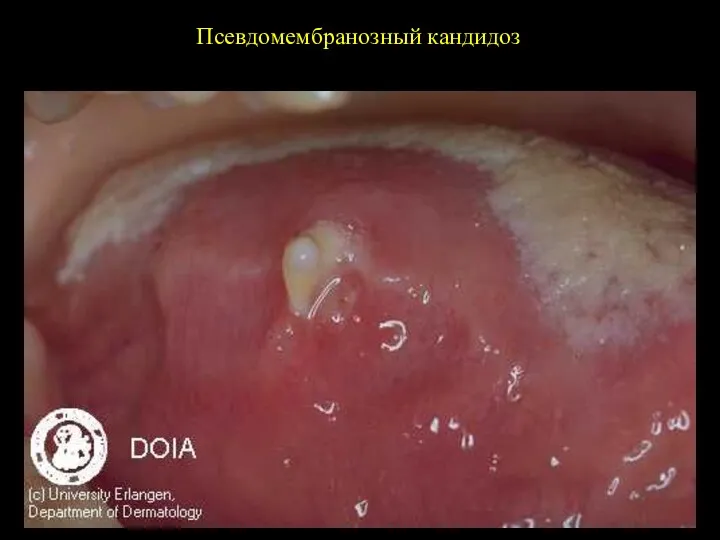 Псевдомембранозный кандидоз