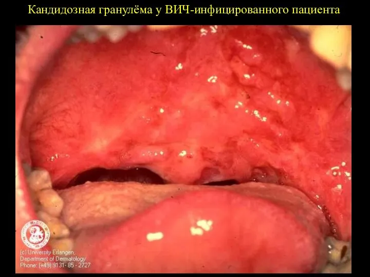 Кандидозная гранулёма у ВИЧ-инфицированного пациента