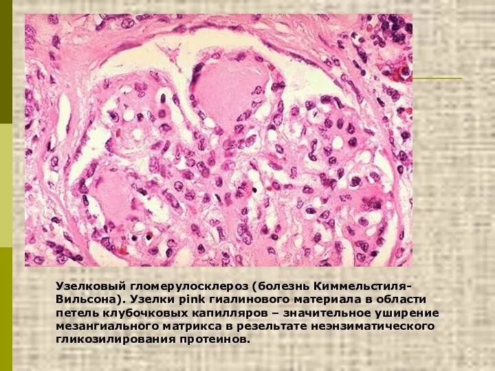 Узелковый гломерулосклероз (болезнь Киммельстиля-Вильсона). Узелки pink гиалинового материала в области