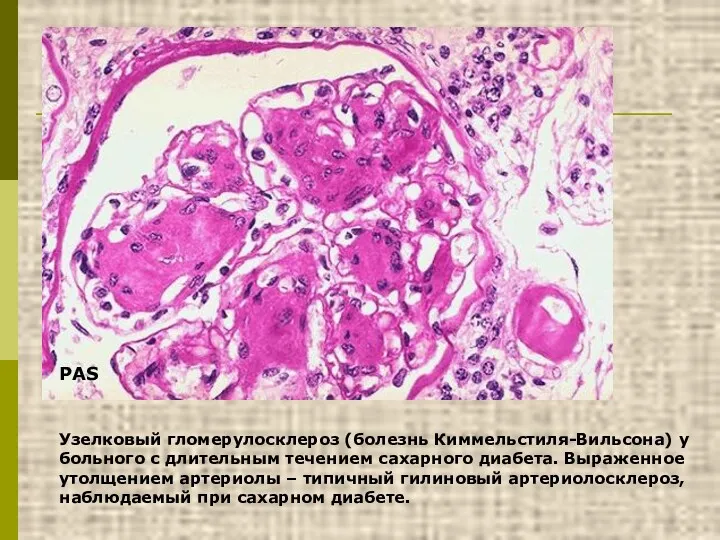 Узелковый гломерулосклероз (болезнь Киммельстиля-Вильсона) у больного с длительным течением сахарного