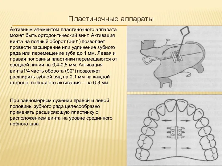 Пластиночные аппараты Активным элементом пластиночного аппарата может быть ортодонтический винт.