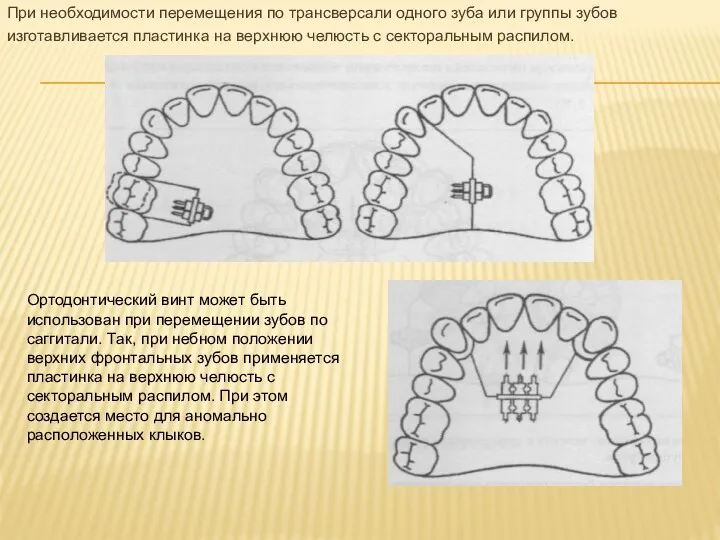 При необходимости перемещения по трансверсали одного зуба или группы зубов