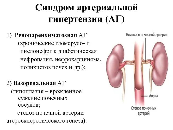 Синдром артериальной гипертензии (АГ) 1) Ренопаренхиматозная АГ (хронические гломеруло- и