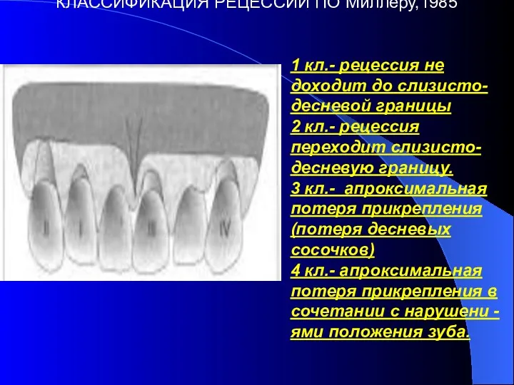 КЛАССИФИКАЦИЯ РЕЦЕССИИ ПО Миллеру,1985 1 кл.- рецессия не доходит до