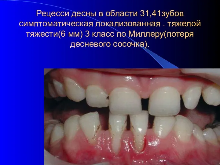 Рецесси десны в области 31,41зубов симптоматическая локализованная . тяжелой тяжести(6