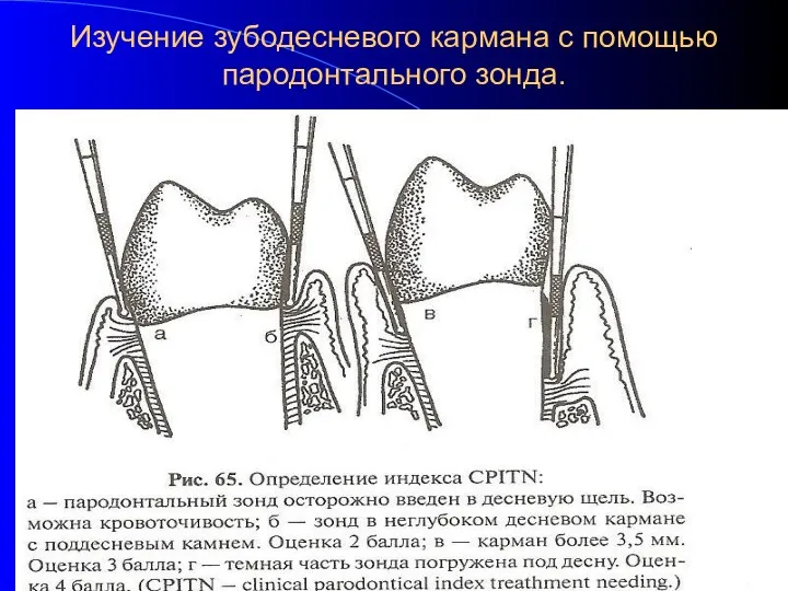 Изучение зубодесневого кармана с помощью пародонтального зонда.