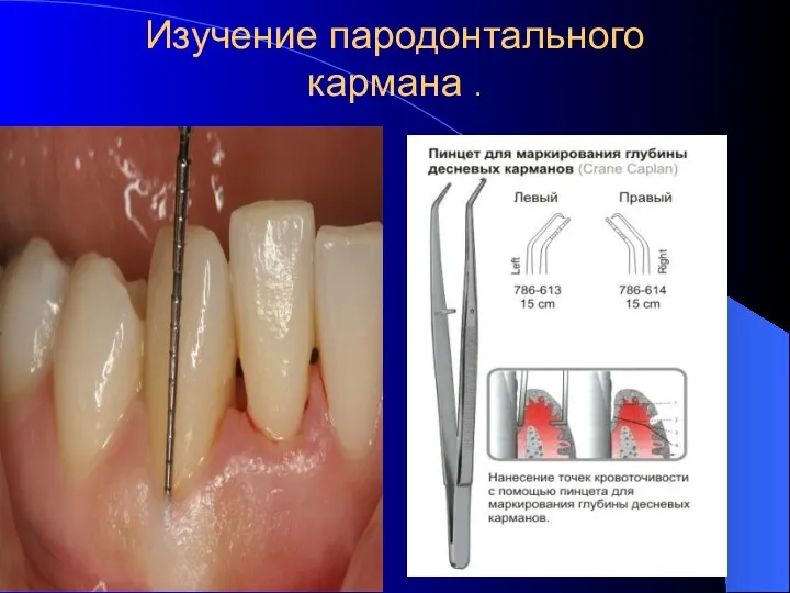 Изучение пародонтального кармана .