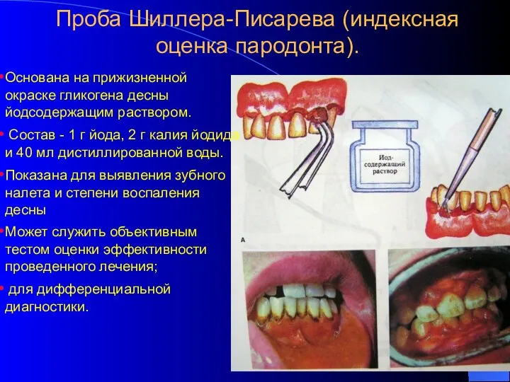 Проба Шиллера-Писарева (индексная оценка пародонта). Основана на прижизненной окраске гликогена