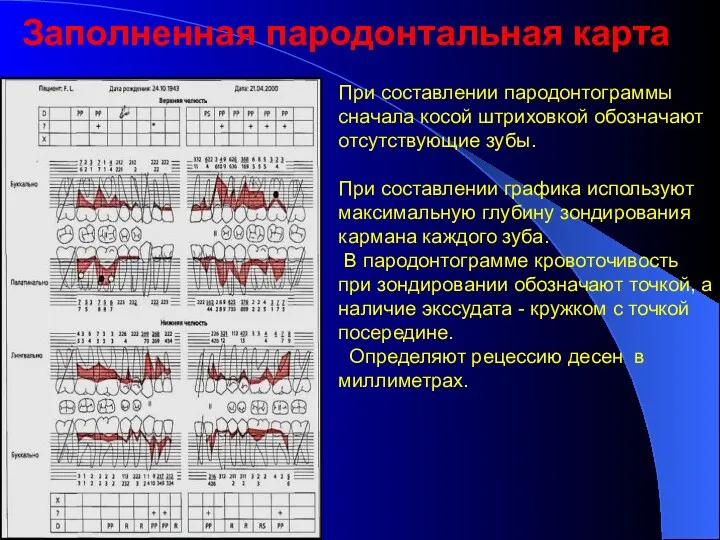 Заполненная пародонтальная карта При составлении пародонтограммы сначала косой штриховкой обозначают