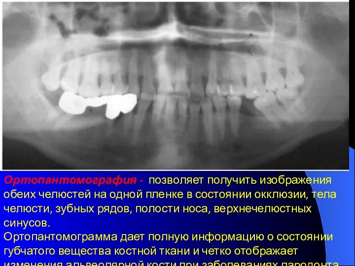 Ортопантомография - позволяет получить изображения обеих челюстей на одной пленке