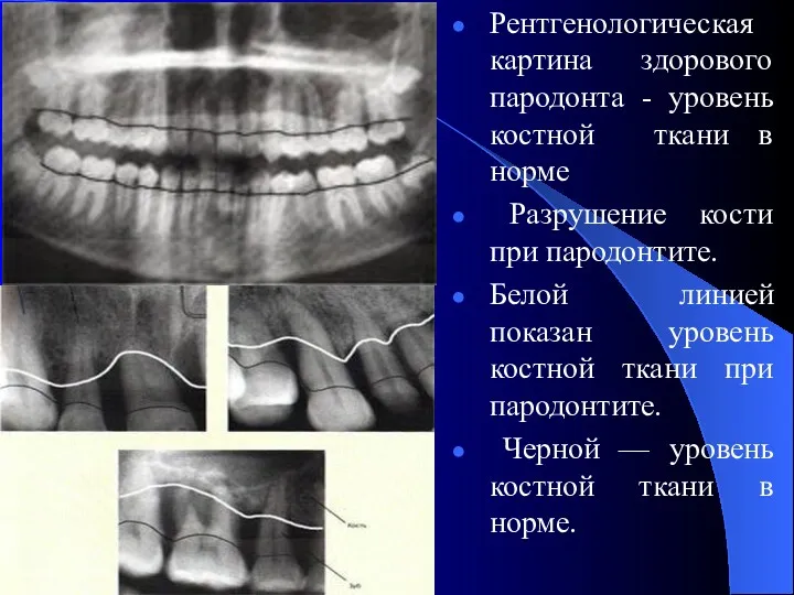Рентгенологическая картина здорового пародонта - уровень костной ткани в норме