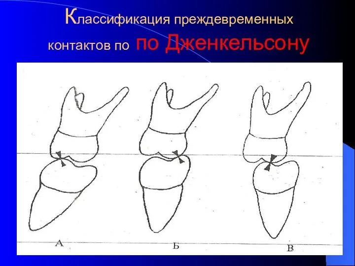 Классификация преждевременных контактов по по Дженкельсону