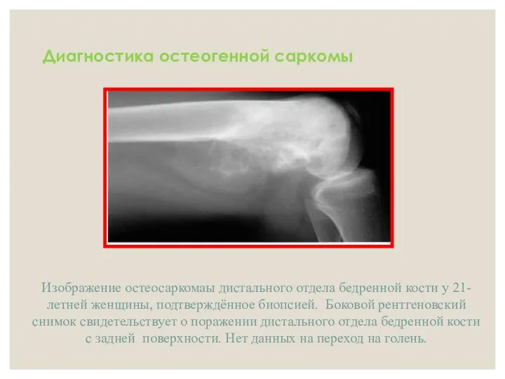 Диагностика остеогенной саркомы Изображение остеосаркомаы дистального отдела бедренной кости у