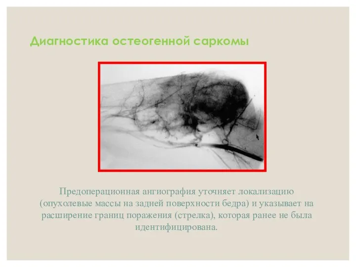 Диагностика остеогенной саркомы Предоперационная ангиография уточняет локализацию (опухолевые массы на