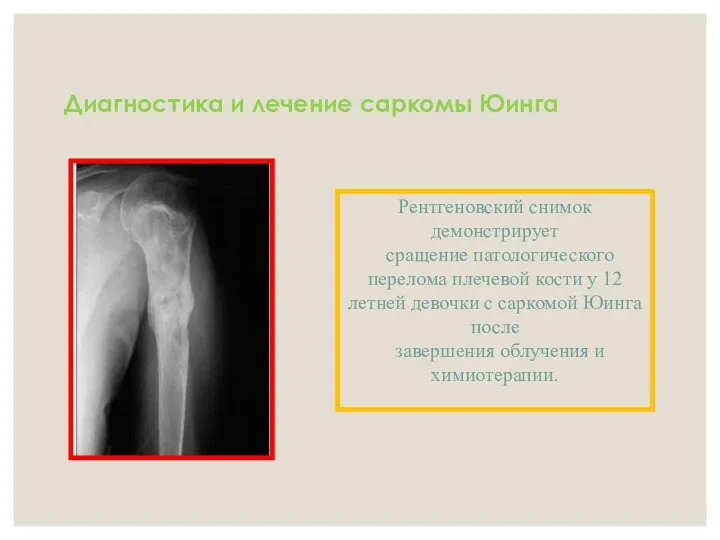 Диагностика и лечение саркомы Юинга Рентгеновский снимок демонстрирует сращение патологического