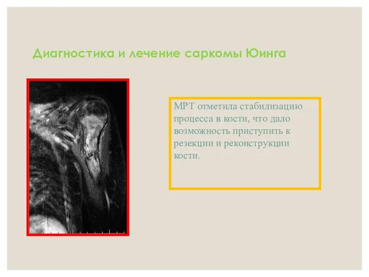 Диагностика и лечение саркомы Юинга МРТ отметила стабилизацию процесса в