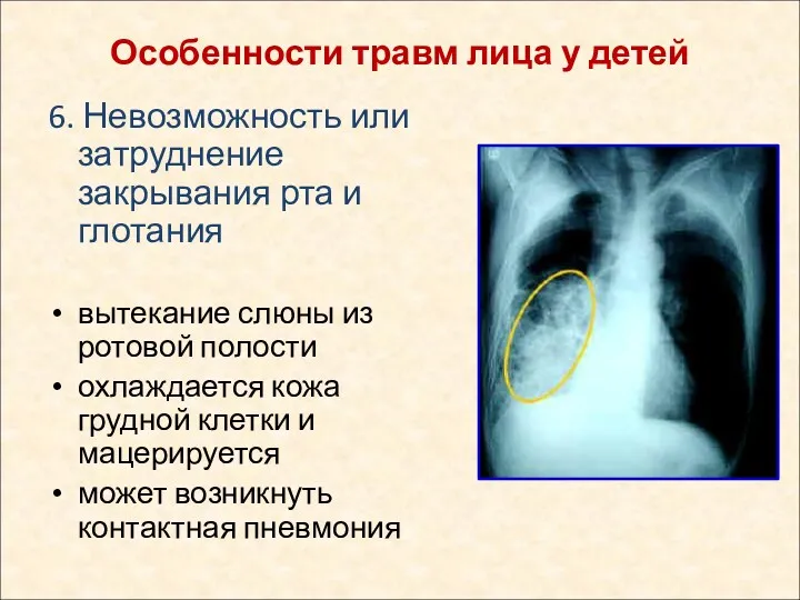 6. Невозможность или затруднение закрывания рта и глотания вытекание слюны