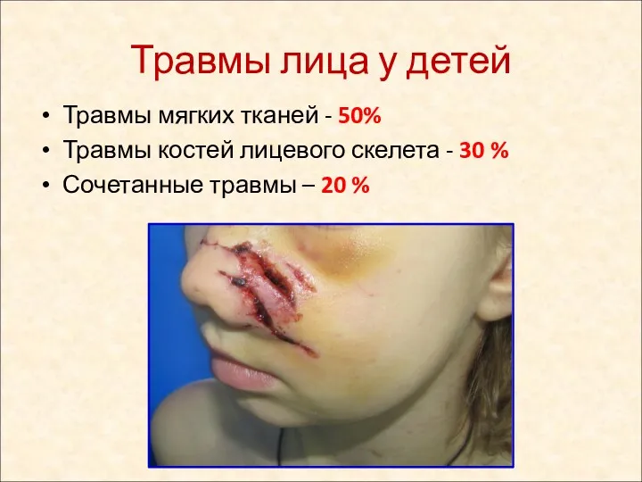 Травмы лица у детей Травмы мягких тканей - 50% Травмы