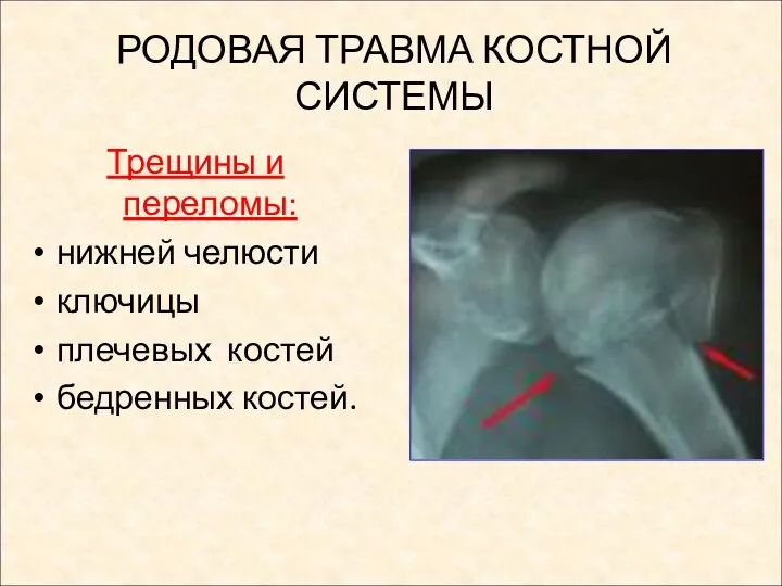 РОДОВАЯ ТРАВМА КОСТНОЙ СИСТЕМЫ Трещины и переломы: нижней челюсти ключицы плечевых костей бедренных костей.