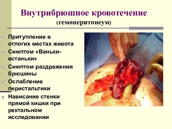 Внутрибрюшное кровотечение (гемоперитонеум) Притупление в отлогих местах живота Симптом «Ваньки-встаньки»