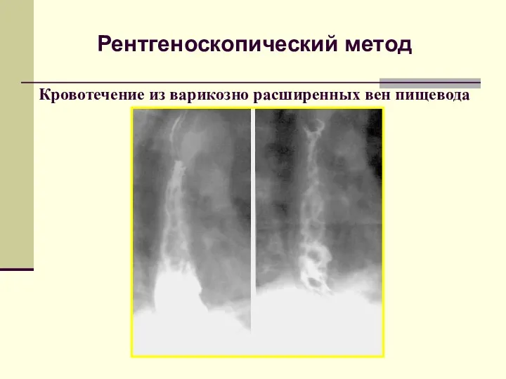 Рентгеноскопический метод Кровотечение из варикозно расширенных вен пищевода
