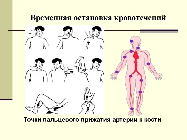 Временная остановка кровотечений Точки пальцевого прижатия артерии к кости