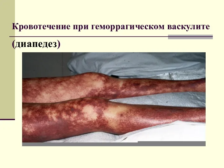 Кровотечение при геморрагическом васкулите (диапедез)
