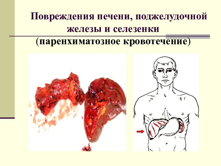 Повреждения печени, поджелудочной железы и селезенки (паренхиматозное кровотечение)