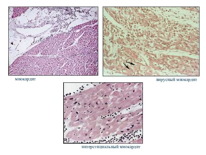 интерстициальный миокардит вирусный миокардит миокардит